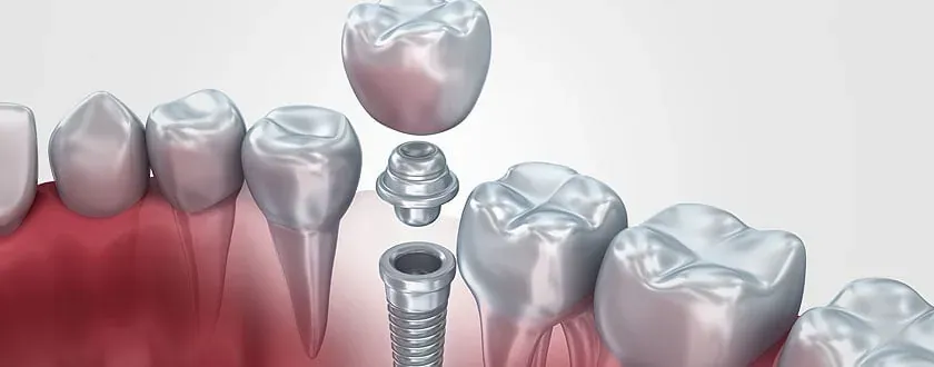 A single implant, connector, and crown beside neighboring teeth