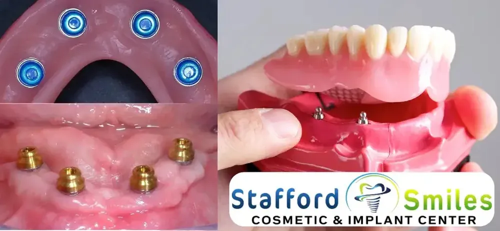 Close-up photos of denture attachments beside an implant denture model